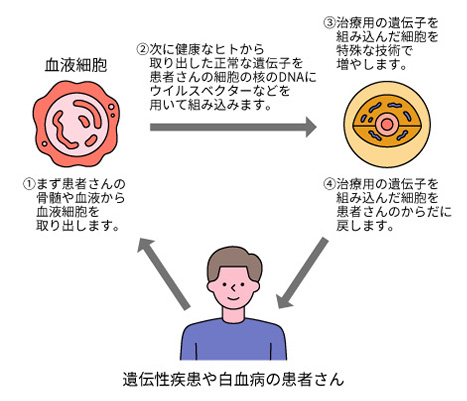 遺伝性疾患に対する遺伝⼦治療の例