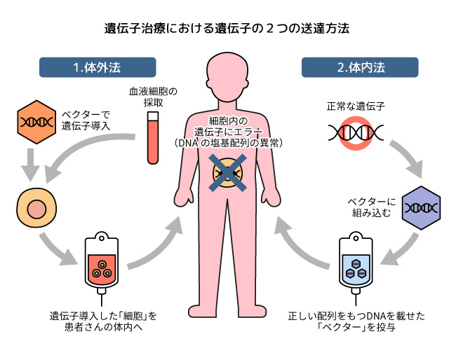 遺伝子治療における遺伝子の2つの送達方法